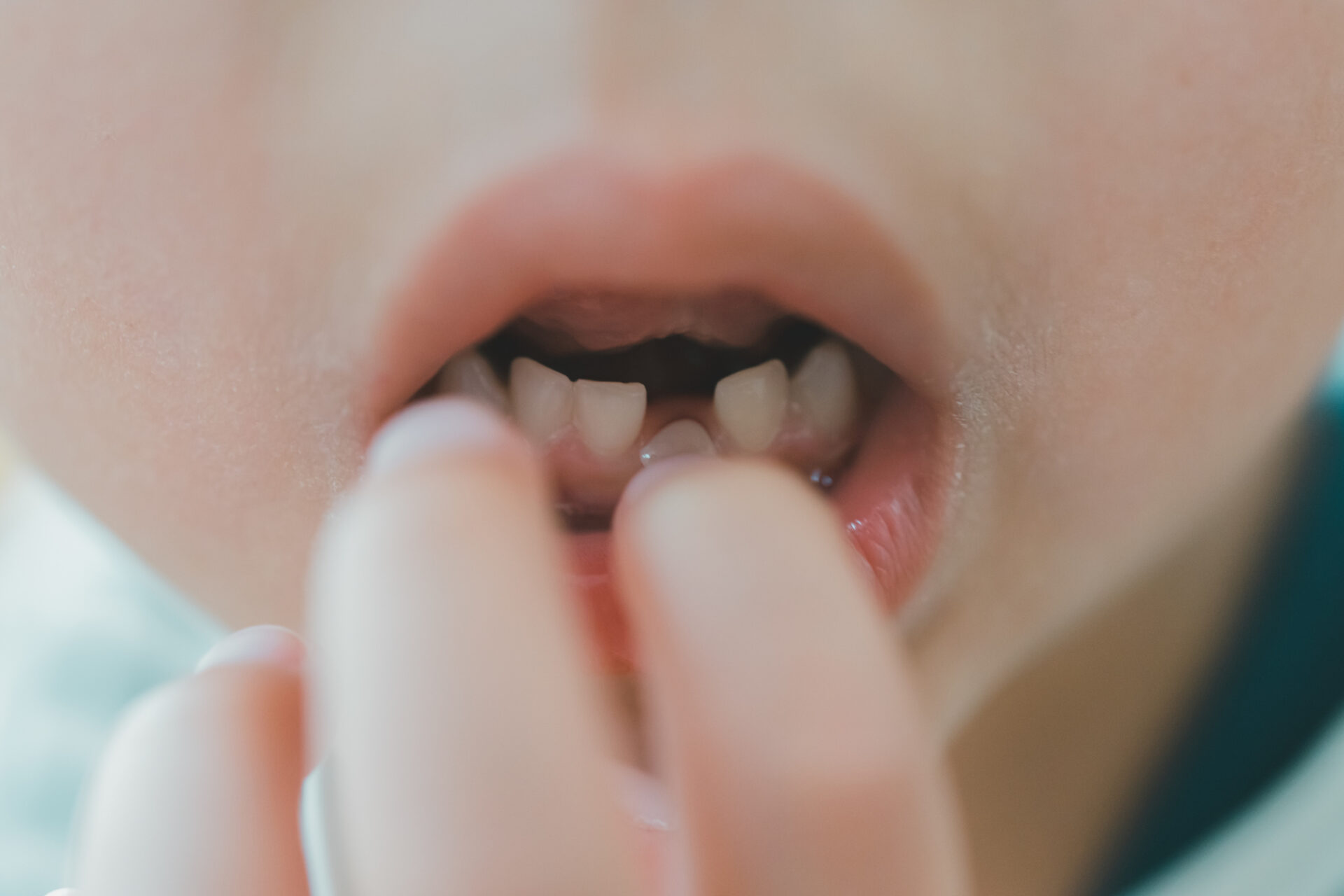 小児 子供の歯 グラグラ