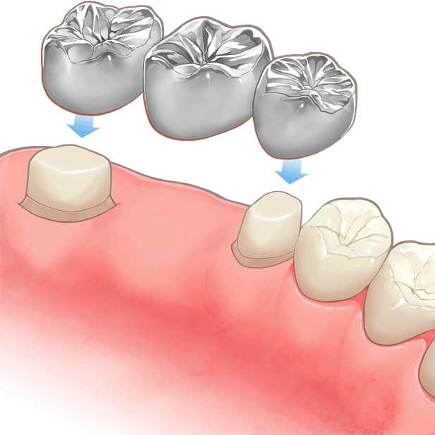 銀歯のブリッジ