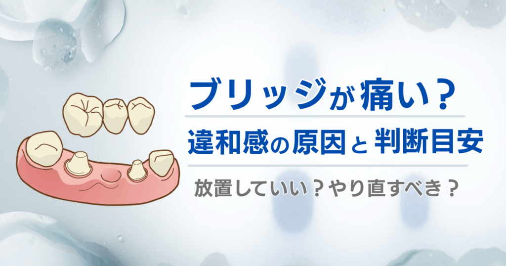 ブリッジが痛い・違和感があるときの原因と放置してよいかの判断目安を解説する記事タイトル画像