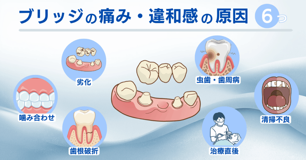 ブリッジが痛い・違和感があるときの主な原因6つ（劣化・虫歯・歯根破折・噛み合わせ・清掃不良・治療直後）を図解で示した画像