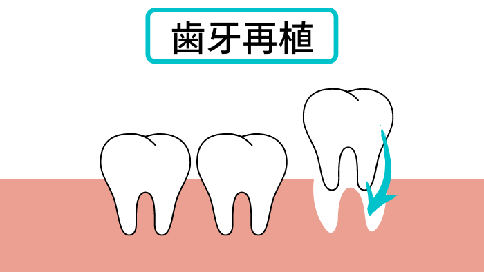 歯牙再植
