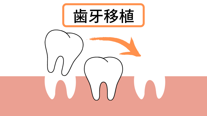 歯牙移植とは？インプラントとの違い