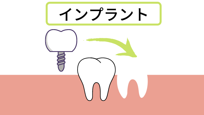 インプラント