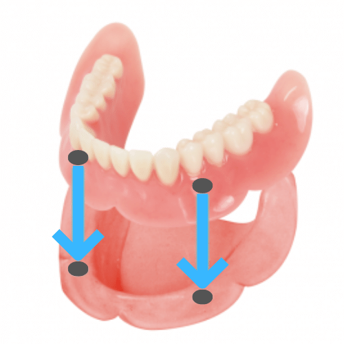 <!-- wp:paragraph --> <p>自分の歯が残っていないと、選択できない</p> <!-- /wp:paragraph -->  <!-- wp:paragraph --> <p>コーヌスクローネ入れ歯を取り扱っている歯医者を探す必要がある</p> <!-- /wp:paragraph -->  <!-- wp:paragraph --> <p>自分の歯を削る必要があるので、天然歯の寿命を縮めてしまう</p> <!-- /wp:paragraph -->  <!-- wp:paragraph --> <p>噛む力が自分の歯に集中するため、歯根破折のリスクが高い</p> <!-- /wp:paragraph -->  <!-- wp:paragraph --> <p>自分の歯と義歯、それぞれに費用がかかるため高額になりやすい</p> <!-- /wp:paragraph -->