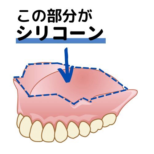 コンフォート義歯