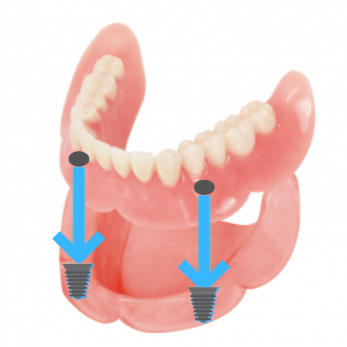 インプラントオーバーデンチャー