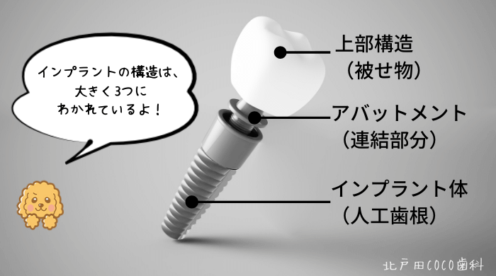 インプラントの構造と歴史