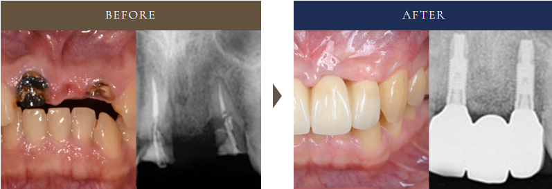 ブリッジの支台歯に虫歯が進行し寿命を迎えた症例。抜歯後に2本のインプラントで再治療し、しっかり噛める美しい仕上がりになった50代女性のビフォーアフター写真とレントゲン画像