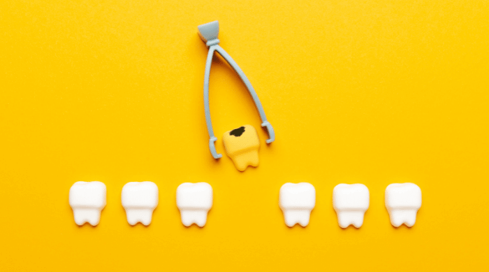 なぜ入れ歯になるのか？歯を失う原因TOP3