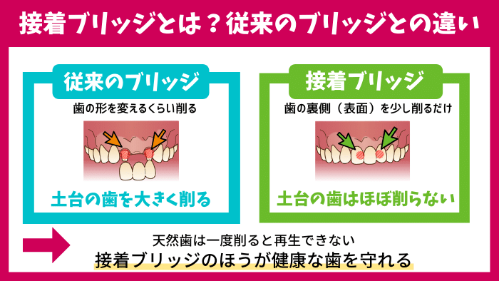 1：接着ブリッジとは？