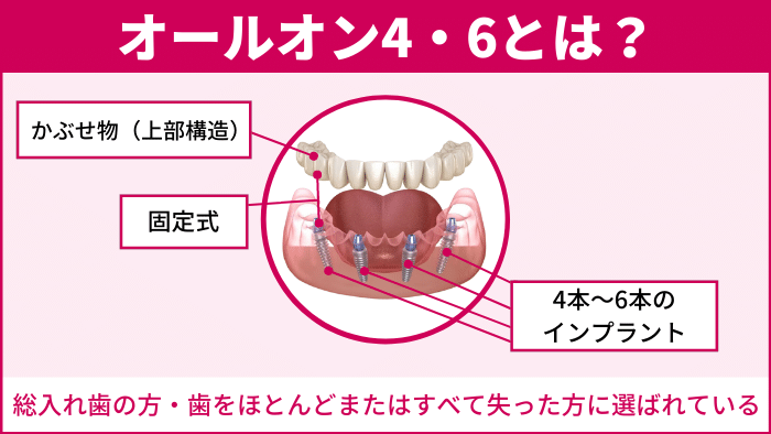 そもそもオールオン4・6とは？