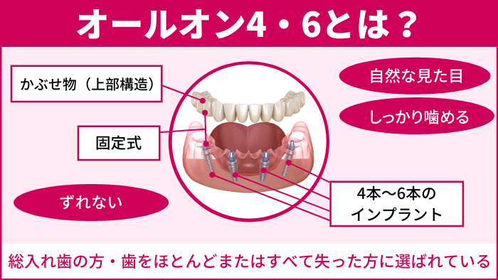 そもそもオールオン4・6とは？向き・不向きはあるの？