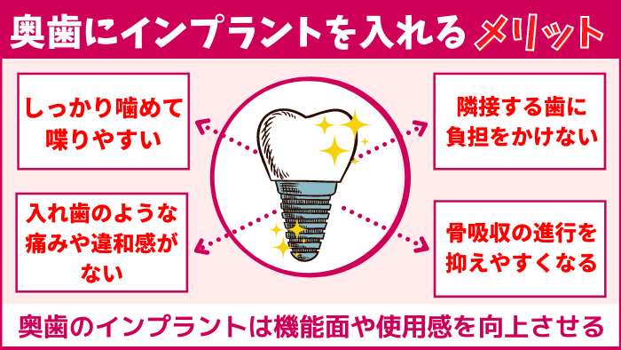インプラントを奥歯に入れる6つのメリット