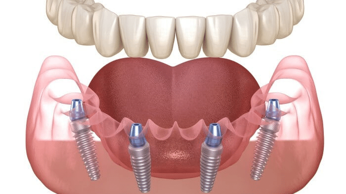 オールオン4の費用！平均相場を歯科医師が解説