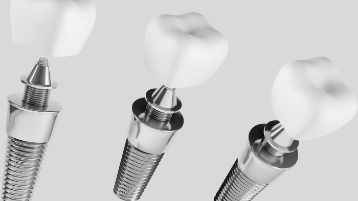 従来のインプラントのみで行う治療と比較した場合