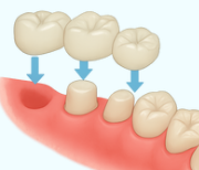 延長ブリッジのイメージ図