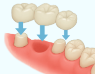 通常のブリッジのイメージ図