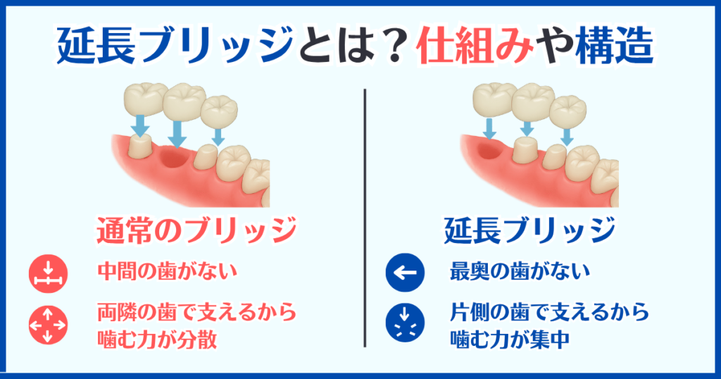 通常のブリッジと延長ブリッジの仕組みや構造の違いを比較した図解。噛む力の分散と集中を視覚的に解説