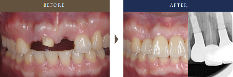 30代男性の前歯に2本のインプラントと骨造成を行った症例。審美性と安定性に配慮した治療のビフォーアフター。