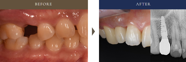50代女性の左上奥歯に1本インプラントを行った症例。治療前後の口腔内写真とレントゲン比較で効果を確認。