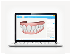 インビザライン とは
