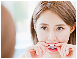 インビザライン とは