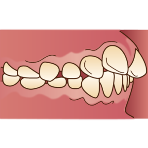 インビザライン 難症例