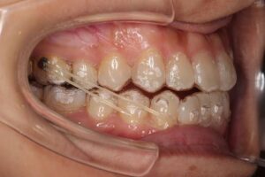 インビザライン 顎間ゴム