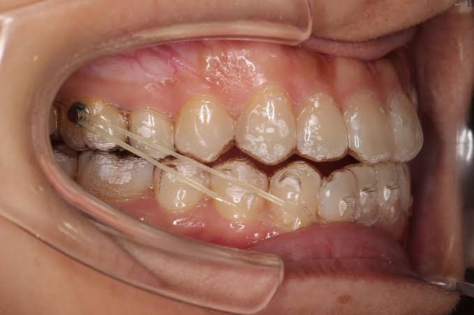 インビザライン 顎間ゴム