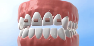 インビザライン アタッチメント