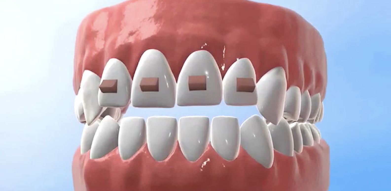 インビザライン アタッチメント