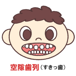 インビザライン すきっ歯