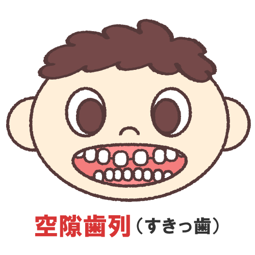 インビザライン すきっ歯