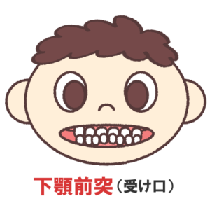 インビザライン しゃくれ