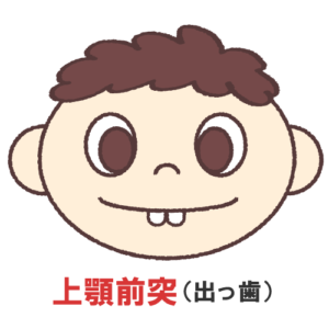 インビザライン 出っ歯