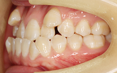 インビザライン 抜歯