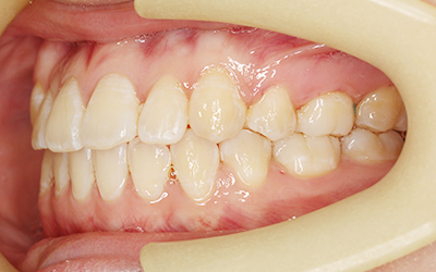 インビザライン 抜歯