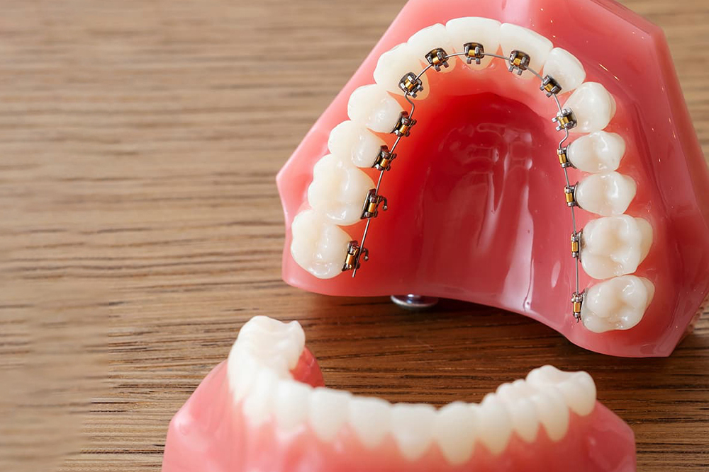 インビザライン 裏側矯正