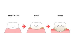 インビザライン 歯肉炎
