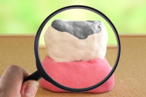 インビザライン 詰め物銀歯