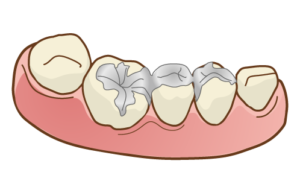 インビザライン 詰め物銀歯