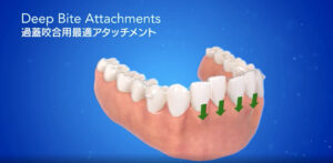 インビザライン  過蓋咬合