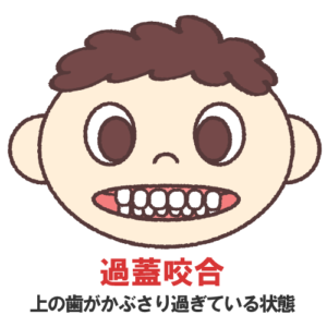 インビザライン 過蓋咬合