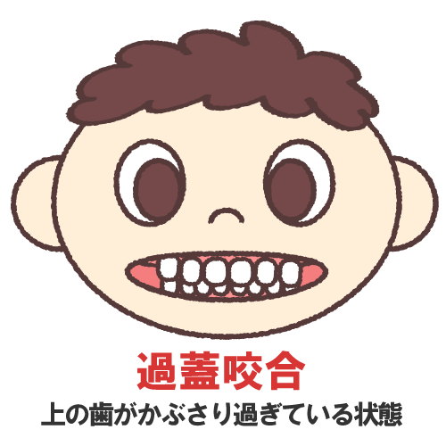 インビザライン 過蓋咬合