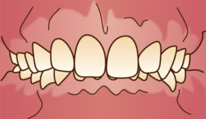 インビザライン 過蓋咬合