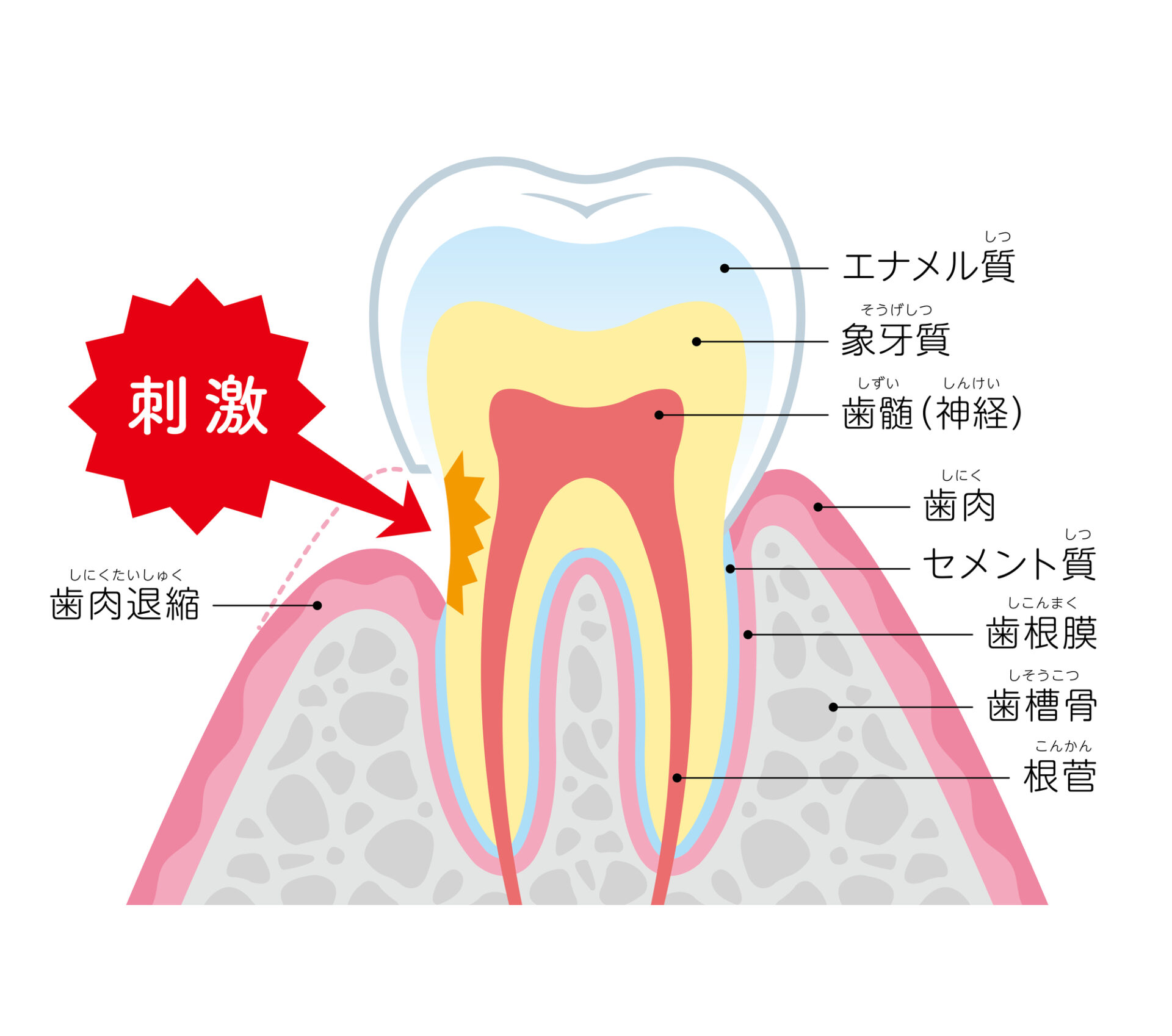 インビザライン 歯肉退縮