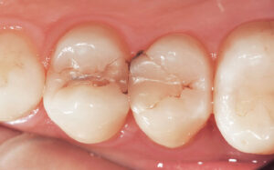 インビザライン 白い詰め物