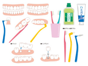 インビザライン ブリッジ