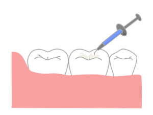 インビザライン 白い詰め物