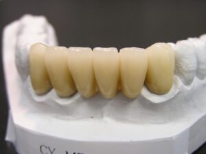 インビザライン　ブリッジ